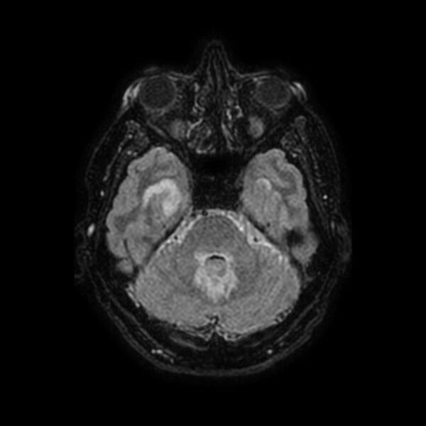 File:Brain abscess complicated by intraventricular rupture and ventriculitis (Radiopaedia 82434-96577 Axial FLAIR 16).jpg