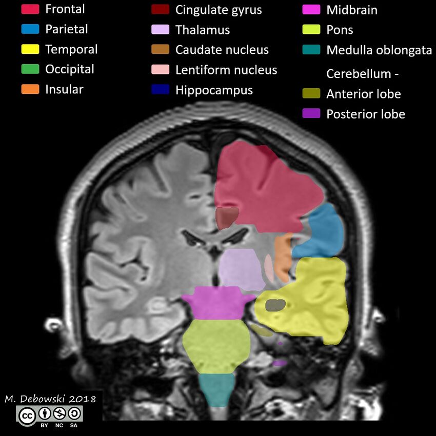 Brain lobes - annotated MRI (Radiopaedia 61691-69700 Coronal 40).JPG