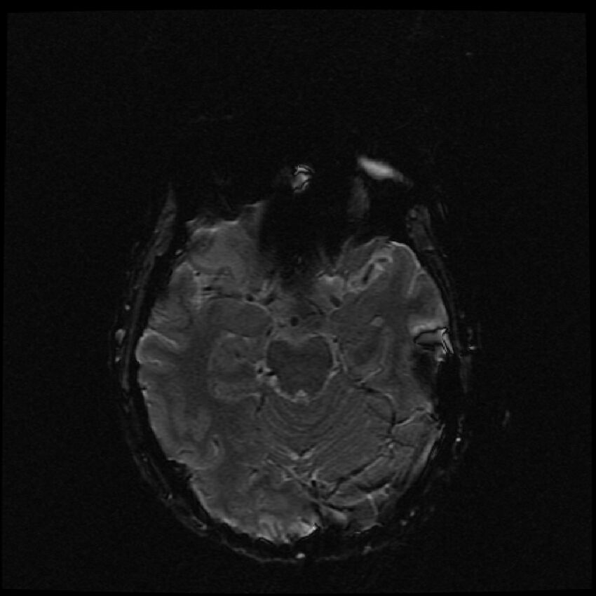 Brain metastases (renal cell carcinoma) (Radiopaedia 42571-45704 Axial SWI 41).jpg