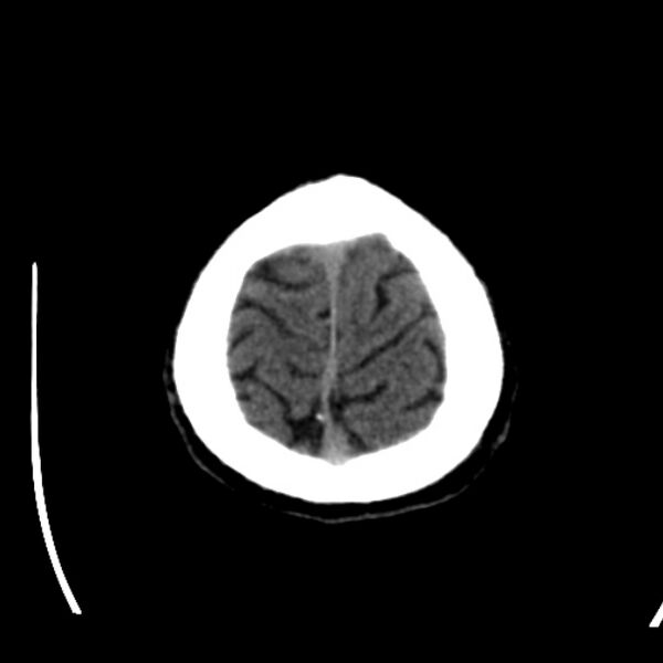 File:Brain metastases from lung cancer (Radiopaedia 24480-24781 Axial non-contrast 47).jpg