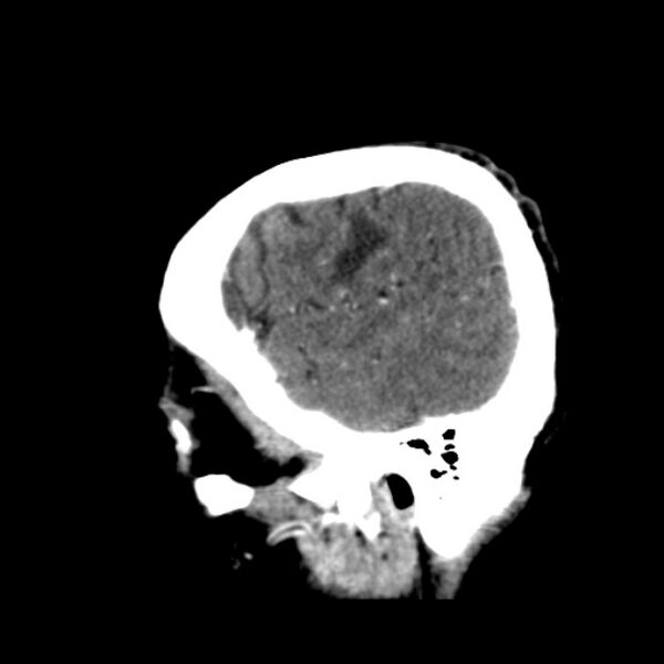 File:Brain metastases from lung cancer (Radiopaedia 24480-24781 C+ delayed 9).jpg