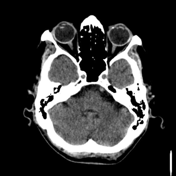 File:Brain metastases from lung cancer (Radiopaedia 27849-28092 Axial non-contrast 12).jpg