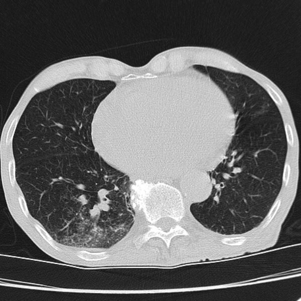 File:Brain metastases from lung cancer (Radiopaedia 27849-28093 Axial lung window 45).jpg