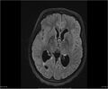 Brainstem glioma (Radiopaedia 21819-21775 Axial FLAIR 20).jpg