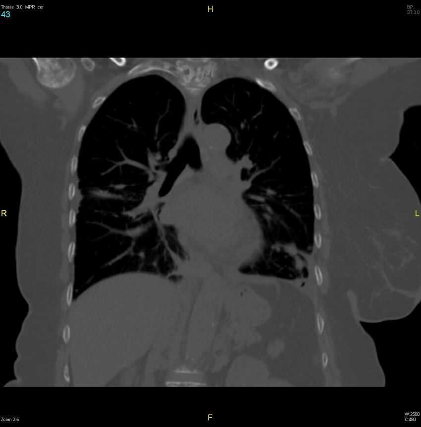 Breast primary with lung and bone metastases (Radiopaedia 40620-43228 bone window 43).jpg