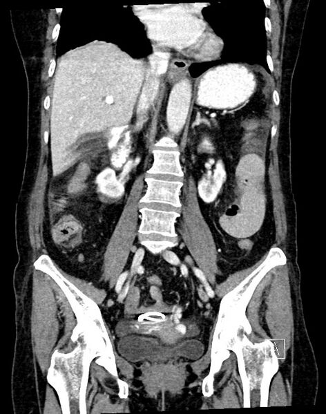 File:Broad ligament hernia (Radiopaedia 84802-100276 B 31).jpg