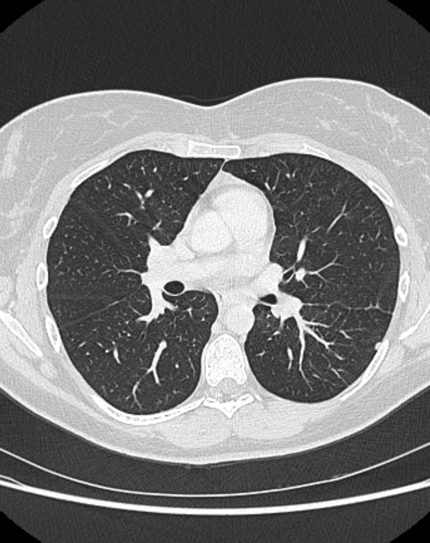 Bronchial atresia (Radiopaedia 50007-55297 Axial lung window 49).jpg
