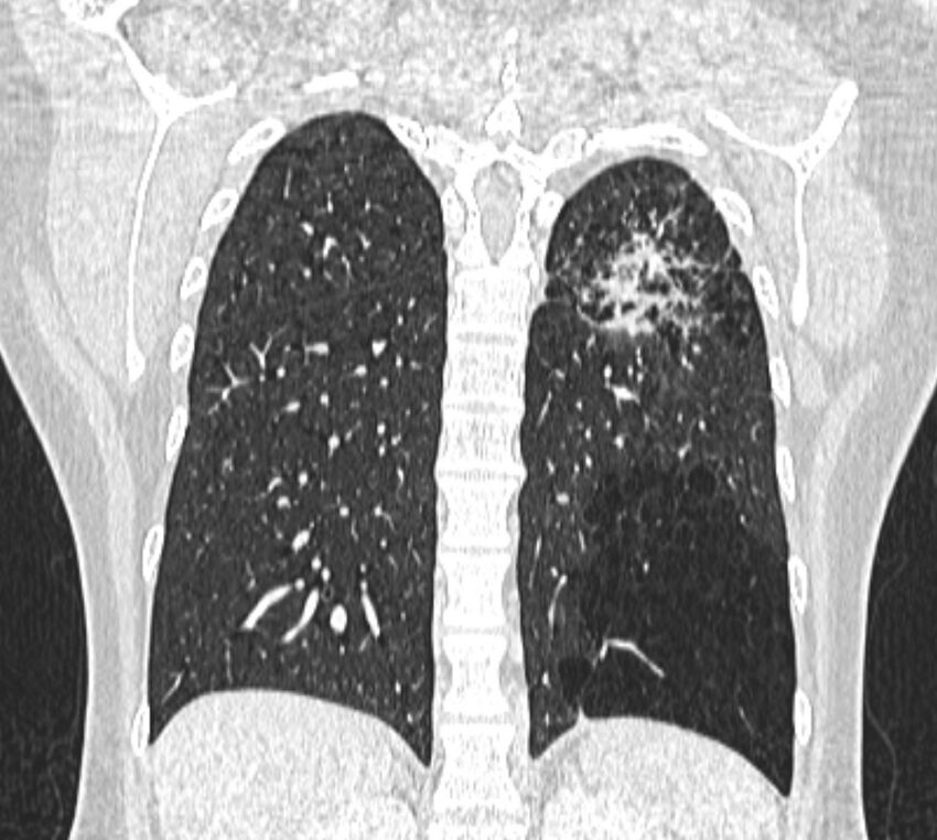 Bronchial atresia (Radiopaedia 50007-55297 Coronal lung window 87).jpg