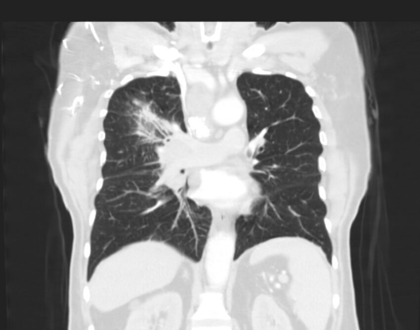 Bronchogenic carcinoma with lymphangitic spread (Radiopaedia 29002-29357 Coronal lung window 36).jpg