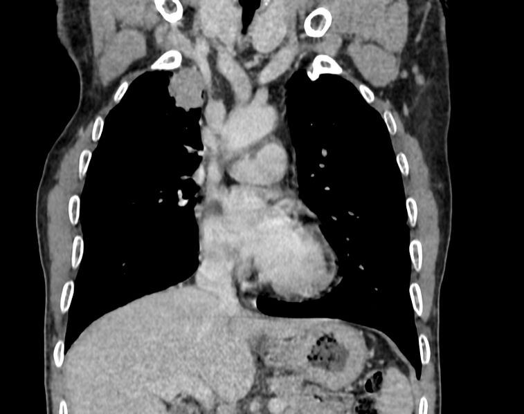 File:Bronchogenic carcinoma with superior vena cava syndrome (Radiopaedia 36497-38054 Coronal C+ delayed 23).jpg