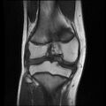 Bucket handle tear - lateral meniscus (Radiopaedia 72124-82634 Coronal T1 11).jpg