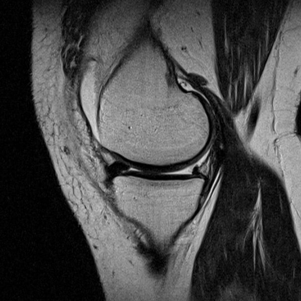 File:Bucket handle tear - medial meniscus (Radiopaedia 79028-91942 Sagittal T2 18).jpg