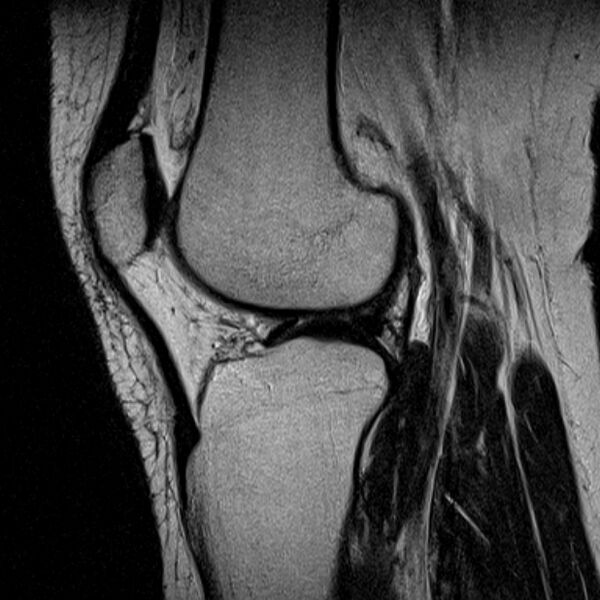 File:Bucket handle tear - medial meniscus (Radiopaedia 79028-91942 Sagittal T2 9).jpg