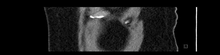 Buried bumper syndrome - gastrostomy tube (Radiopaedia 63843-72575 Sagittal Inject 114).jpg