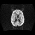 Burkitt lymphoma of the orbit- pre and post chemotherapy (Radiopaedia 31214-31930 Axial DWI 11).jpg