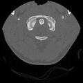 C5 facet fracture (Radiopaedia 58374-65499 Axial bone window 12).jpg