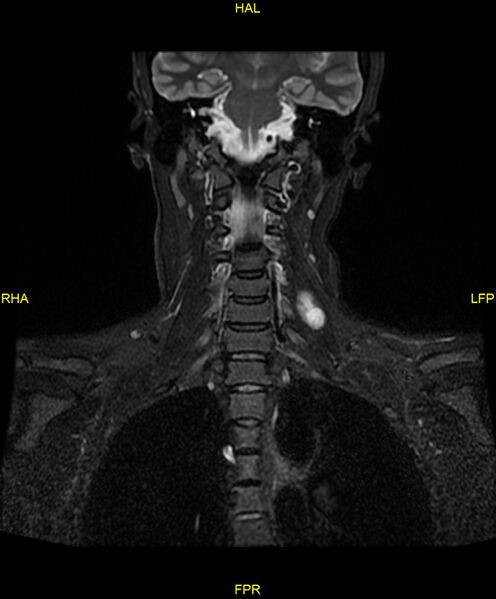 File:C5 nerve sheath tumor (Radiopaedia 85777-101596 Coronal T2 fat sat 11).jpg