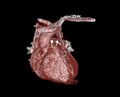 CABG graft occlusion due to competitive flow from native artery (Radiopaedia 30801-31508 3D 2).jpg
