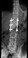 Calcaneal fracture and associated spinal injury (Radiopaedia 17896-17660 E 1).jpg