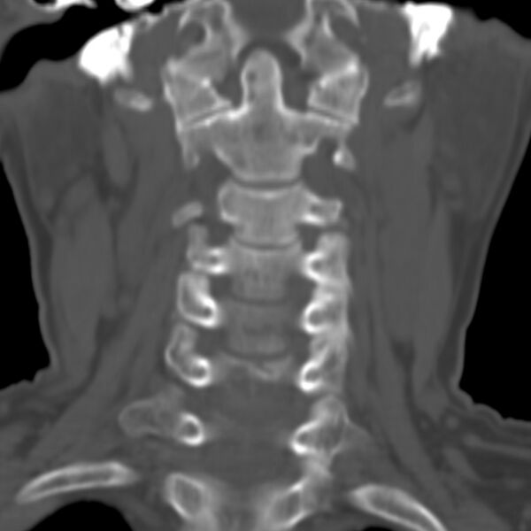 File:Calcified meningioma - cervical canal (Radiopaedia 70136-80171 Coronal bone window 7).jpg