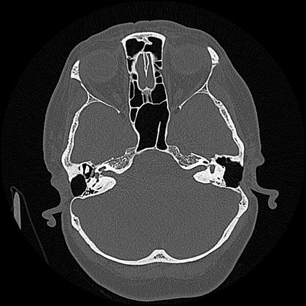 File:Canal up mastoidectomy (Radiopaedia 78108-90638 Axial bone window 79).jpg