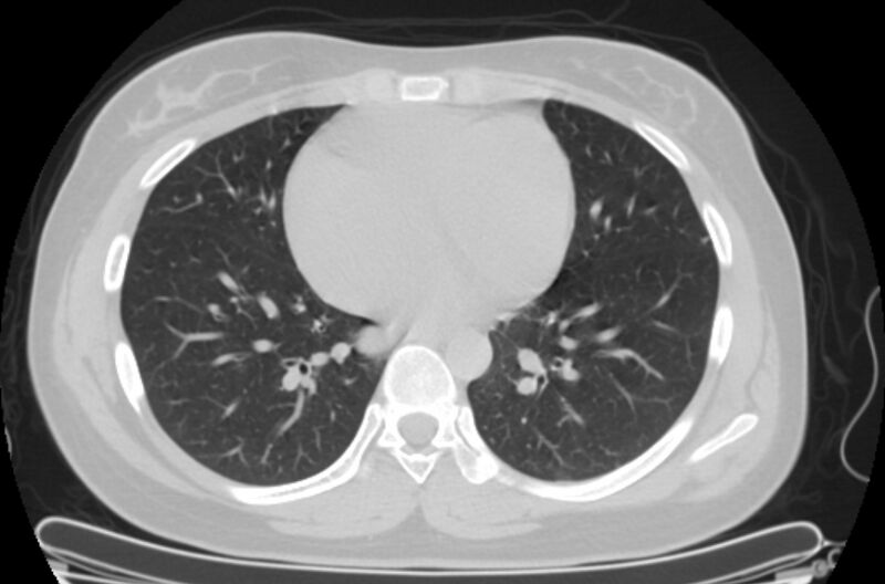 File:Cannonball metastases - uterine choriocarcinoma (Radiopaedia 70137-80173 Axial lung window 68).jpg