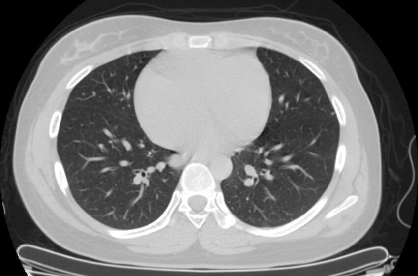Cannonball metastases - uterine choriocarcinoma (Radiopaedia 70137-80173 Axial lung window 68).jpg