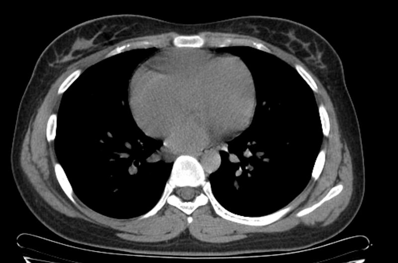 File:Cannonball metastases - uterine choriocarcinoma (Radiopaedia 70137-80173 Axial non-contrast 73).jpg