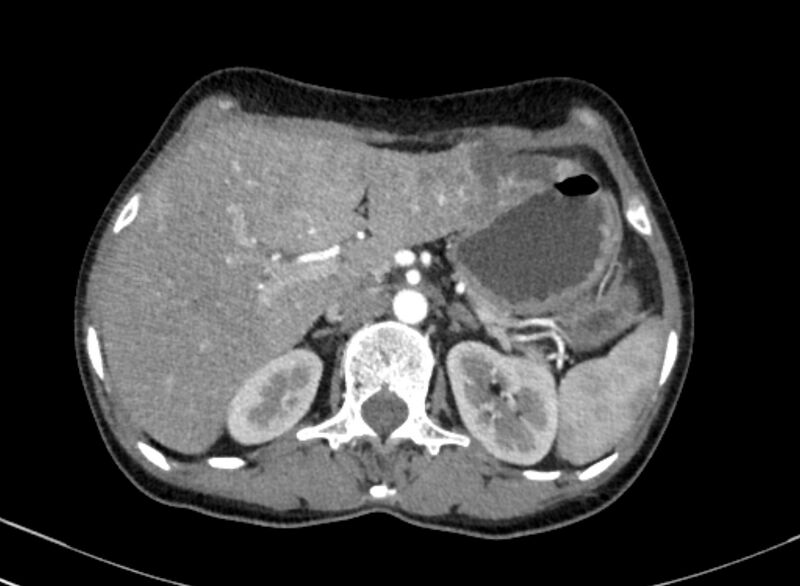 File:Cannonball metastases from breast cancer (Radiopaedia 91024-108569 A 123).jpg