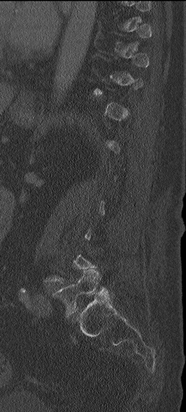 File:Cannonball metastases from endometrial cancer (Radiopaedia 42003-45031 H 17).png