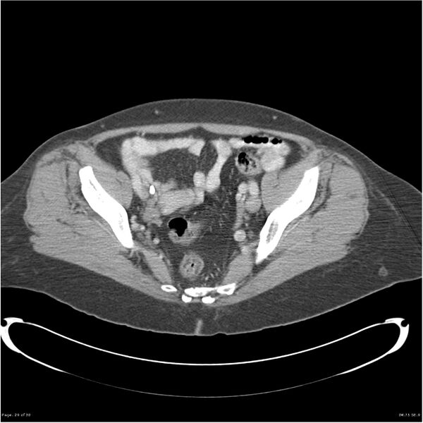 File:Carcinoid tumor of the ileum with metastasis to orbit (Radiopaedia 28165-28425 A 29).jpg