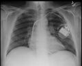 Cardiac pacer (Radiopaedia 11276-11640 A 1).jpg