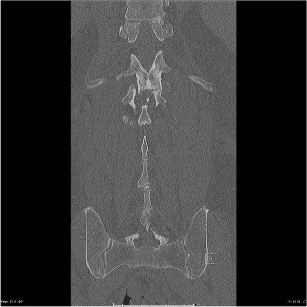 File:Cardiac trauma (Radiopaedia 32874-33858 Coronal bone window 83).jpg