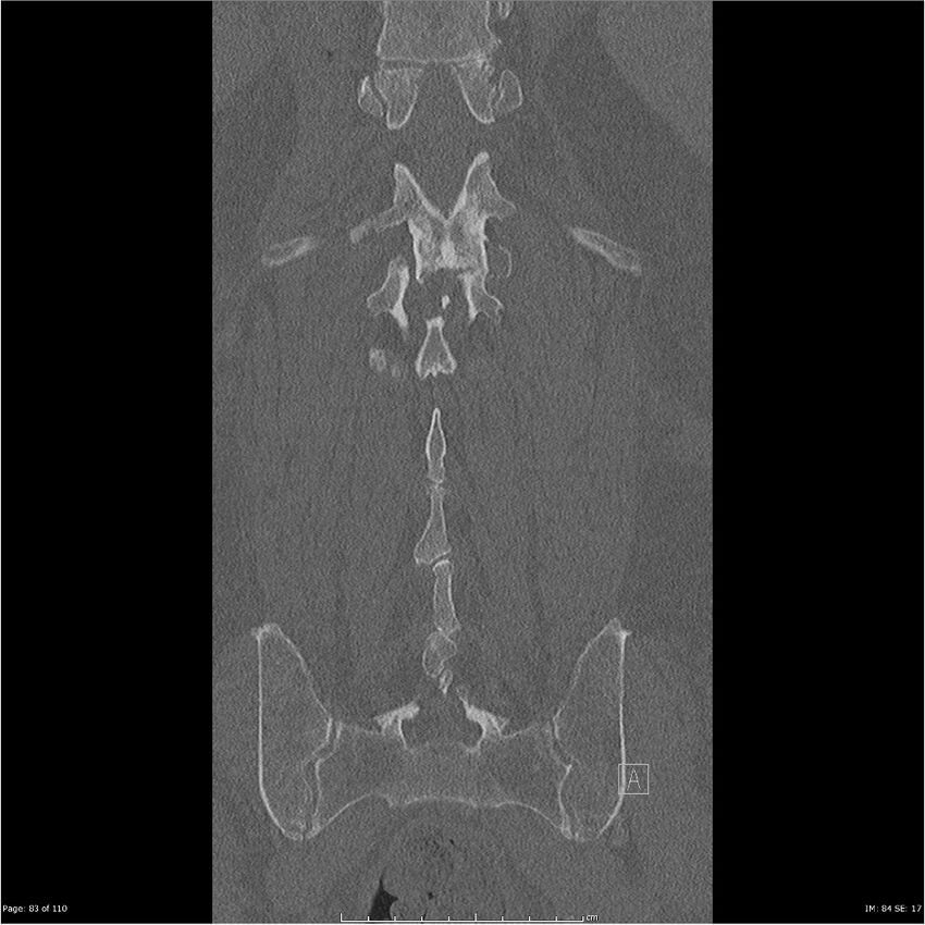 Cardiac trauma (Radiopaedia 32874-33858 Coronal bone window 83).jpg