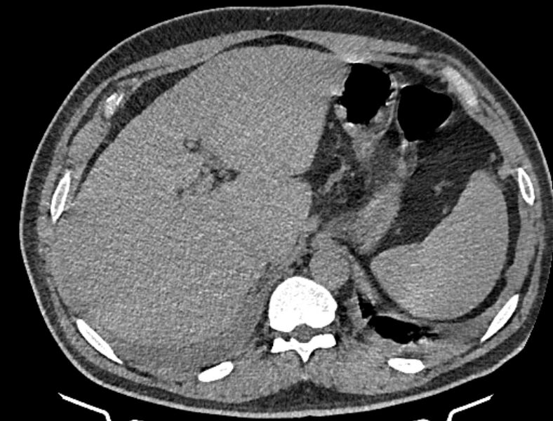 File:Cardiogenic pulmonary edema (Radiopaedia 68180-77678 Axial non-contrast 57).jpg