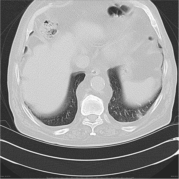File:Cavitating left lower lobe lesion - squamous cell lung cancer (Radiopaedia 27749-28176 Axial lung window 42).jpg