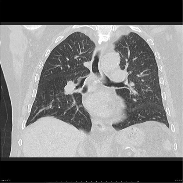 File:Cavitating left lower lobe lesion - squamous cell lung cancer (Radiopaedia 27749-28176 Coronal lung window 31).jpg