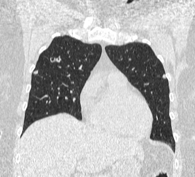 File:Cavitating pulmonary metastases (Radiopaedia 17796-17555 Coronal lung window 4).jpg