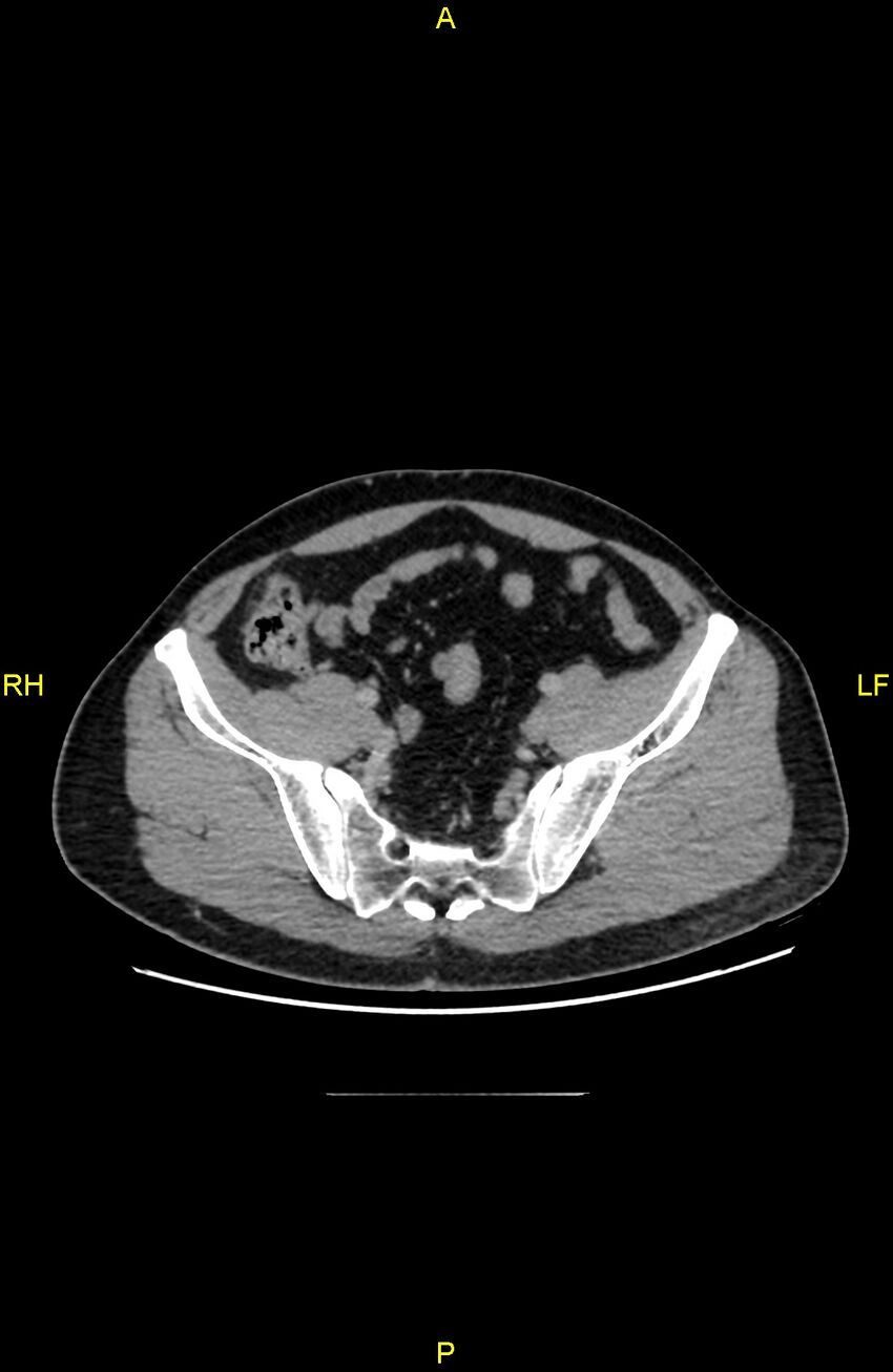 Cecal epiploic appendagitis (Radiopaedia 86047-102164 A 121).jpg