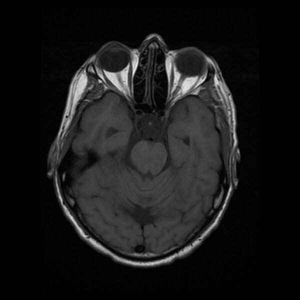 File:Central neurocytoma (Radiopaedia 67618-77021 Axial T1 9).jpg