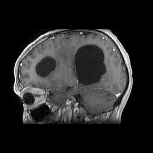 File:Central neurocytoma (Radiopaedia 67618-77021 Sagittal T1 C+ 10).jpg