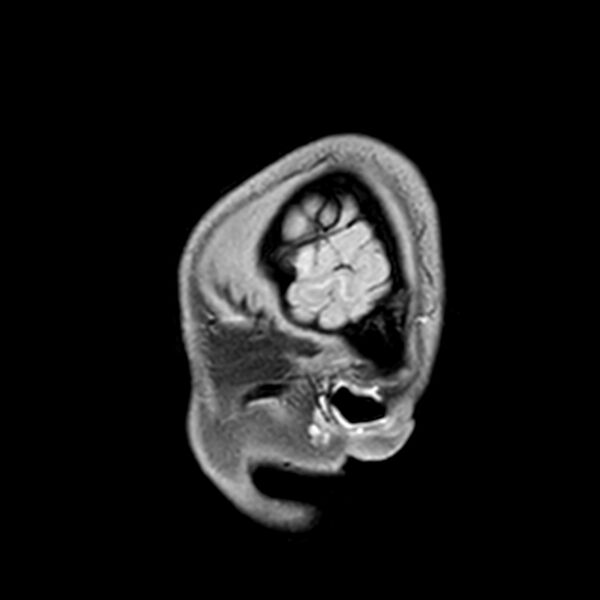 File:Central neurocytoma (Radiopaedia 79320-92380 Sagittal T1 23).jpg