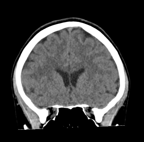 File:Cerebellar agenesis (Radiopaedia 30203-30817 Coronal non-contrast 8).jpg