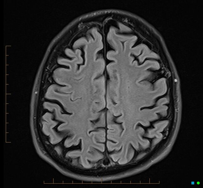 File:Cerebellar gangliocytoma (Radiopaedia 65377-74422 Axial FLAIR 29).jpg