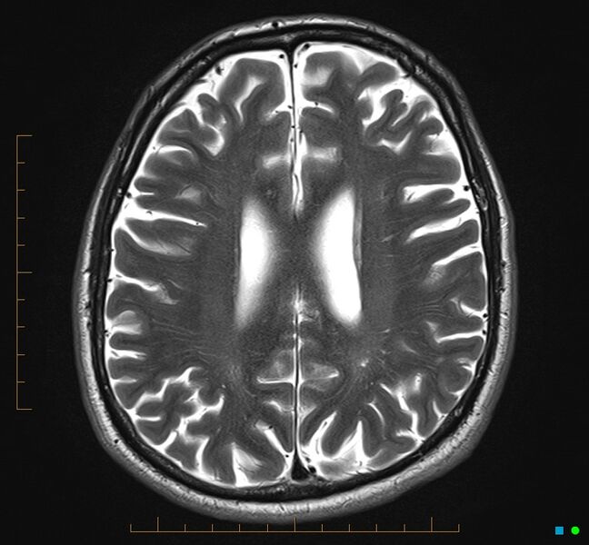 File:Cerebellar gangliocytoma (Radiopaedia 65377-74422 Axial T2 26).jpg