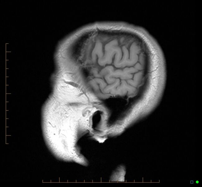 File:Cerebellar gangliocytoma (Radiopaedia 65377-74422 Sagittal T1 41).jpg