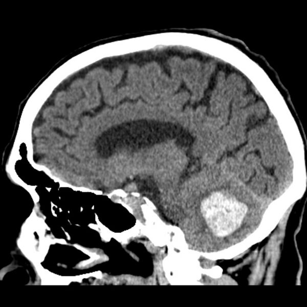 File:Cerebellar hemorrhage (Radiopaedia 27193-27359 C 26).jpg