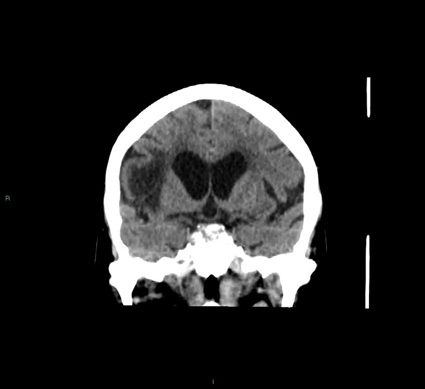 Cerebellar hemorrhage (Radiopaedia 58793-66027 Coronal non-contrast 42).jpg