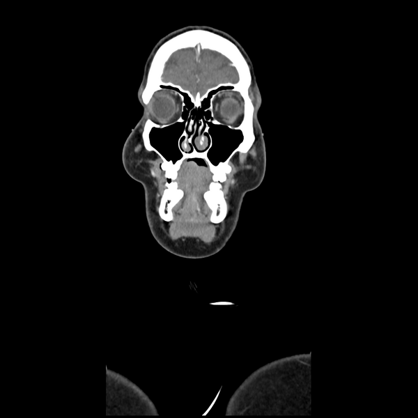 File:Cerebellar infarct due to vertebral artery dissection with posterior fossa decompression (Radiopaedia 82779-97029 D 10).png