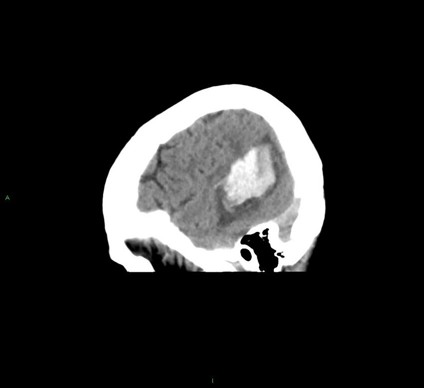 Cerebral amyloid angiopathy-associated lobar intracerebral hemorrhage (Radiopaedia 58378-65516 C 9).jpg